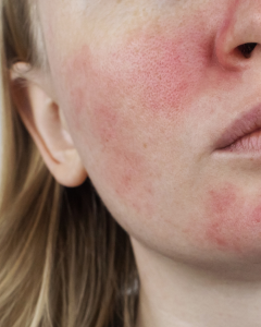 sensitive skin facial treatment springfield missouri