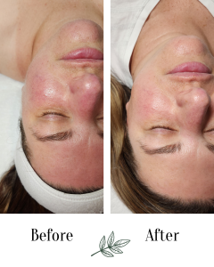 sensitive skin facial treatment springfield missouri